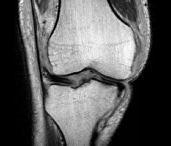 Irreducible knee MRI